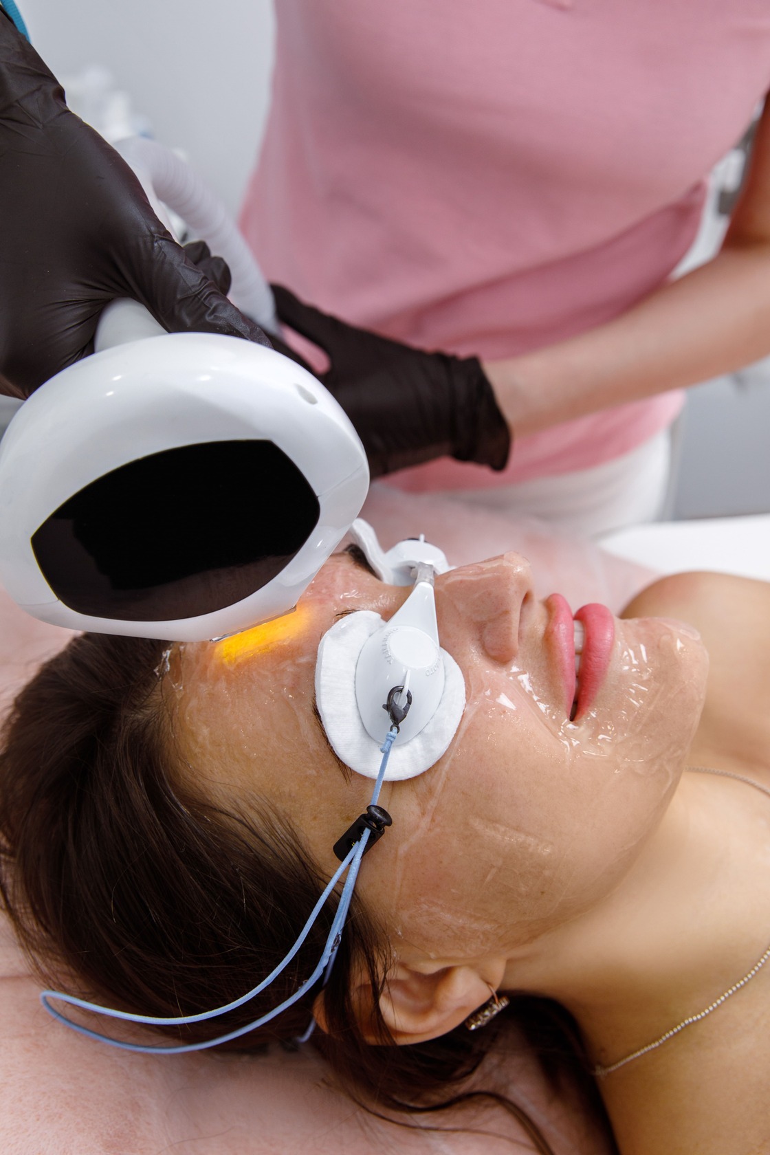 Лазерне видалення пігментації у Львові